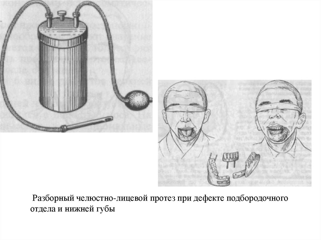 Классификация челюстно лицевых и лицевых протезов презентация