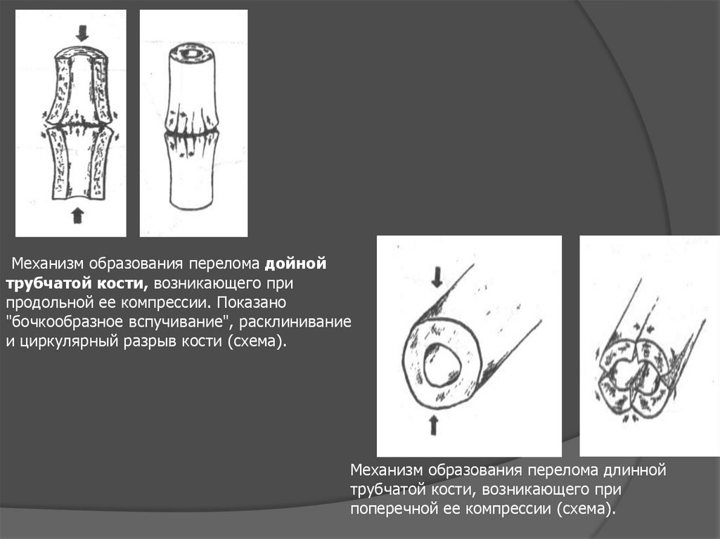 Переломы трубчатых костей