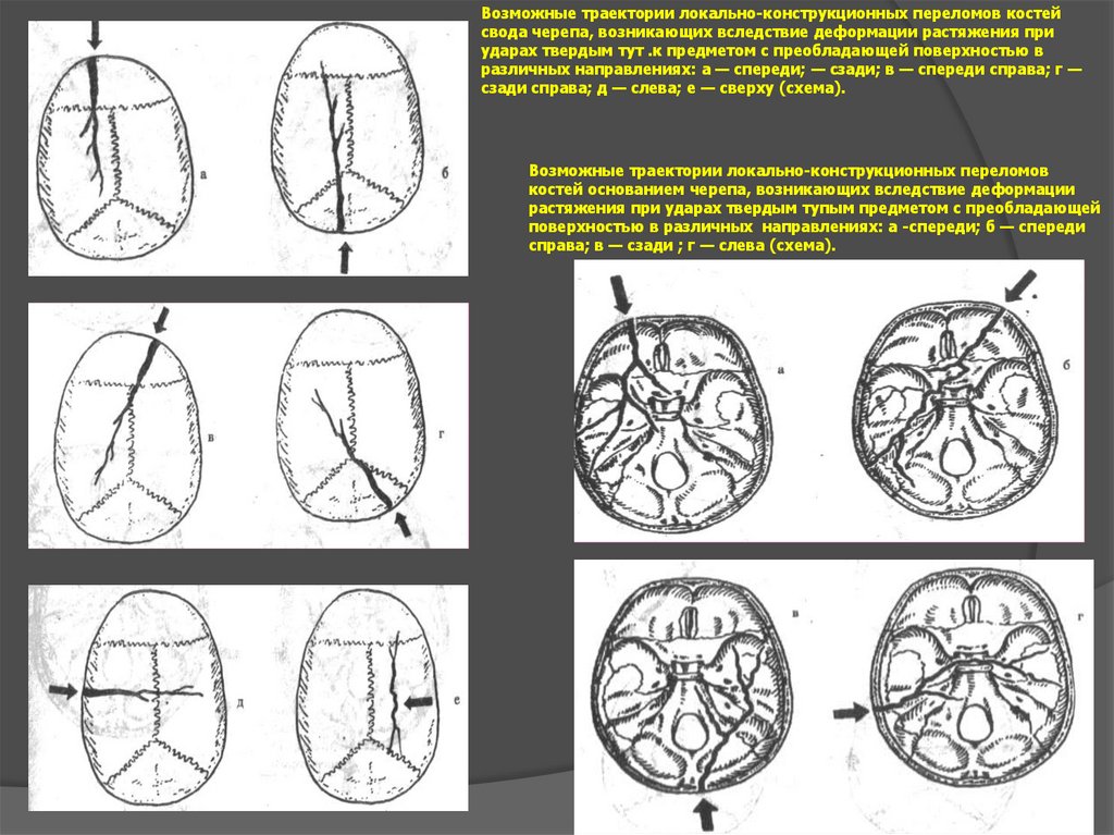 Перелом основания свода. Переломы костей черепа классификация. Классификация переломов костей свода черепа. Перелом основания свода черепа схема. Метод диагностики перелома костей основания черепа.