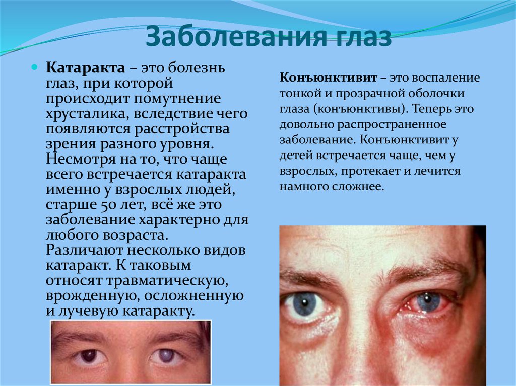 Нарушение глаза. Заболевания глаз список. Симптомы заболевания глаз.