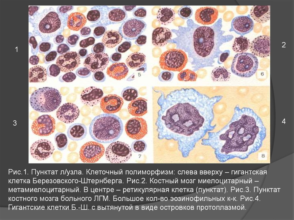 Цитологическая картина лимфомы ходжкина