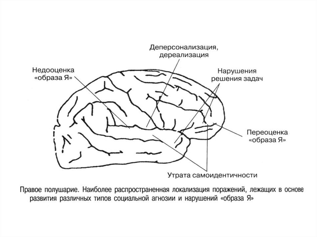 Нарушение схемы тела наблюдается при следующем виде агнозии