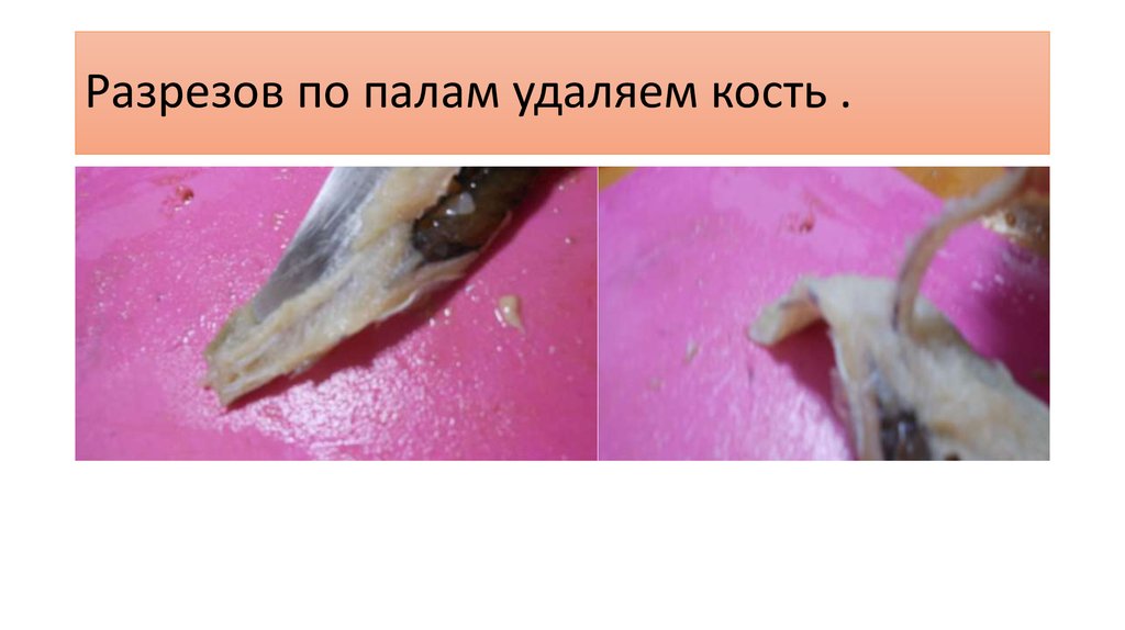 Разрезов по палам удаляем кость .