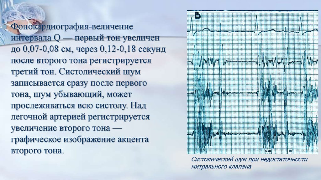 Аускультативная картина при митральном стенозе сердца включает тест