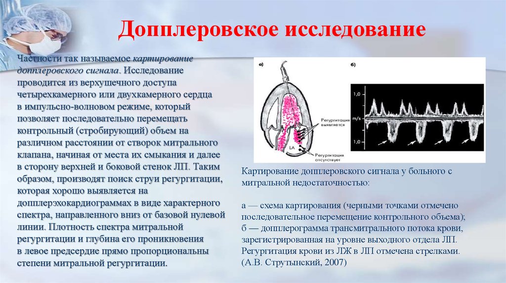 Митральная регургитация 1 степени