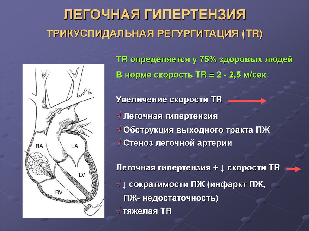 Легочная артериальная гипертензия презентация