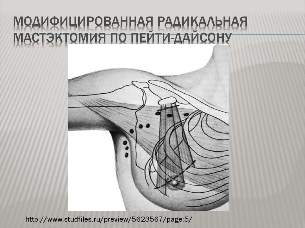 Мастэктомия по холстеду