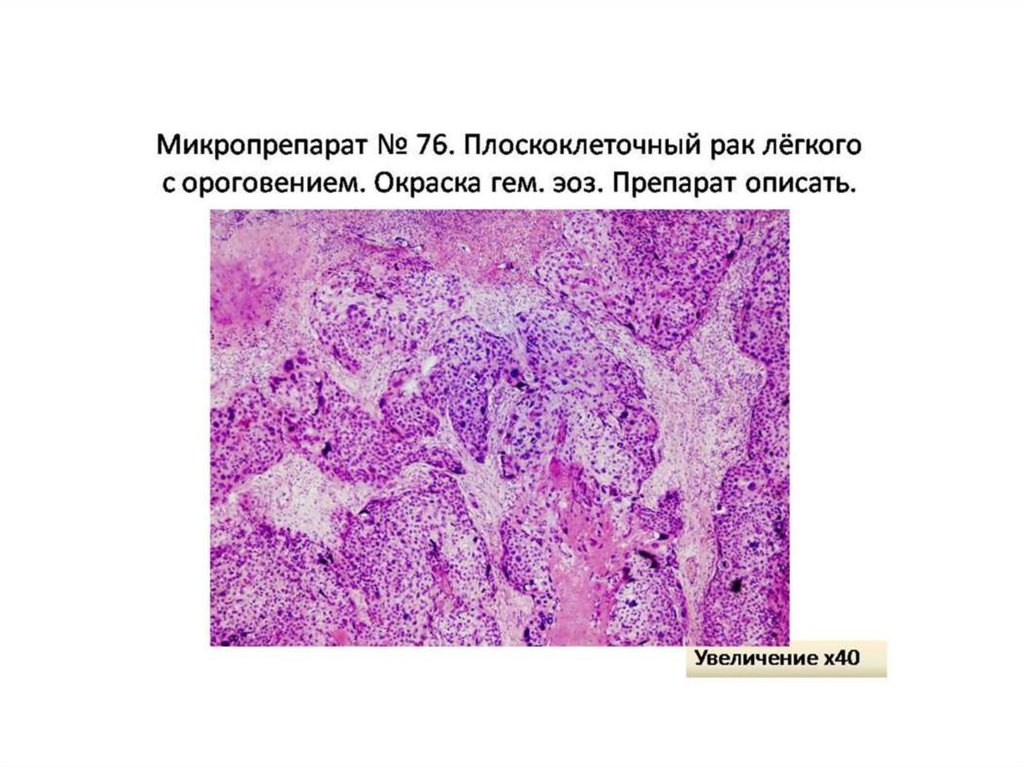 Стадии рака легких плоскоклеточный. Гриппозная пневмония микропрепарат. Плоскоклеточная карцинома кожи гистология. Макропрепарат легкого Патан. Плоскоклеточная карцинома легкого гистология.