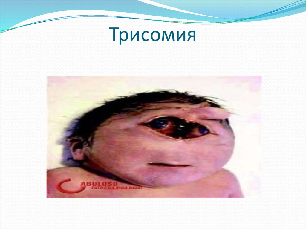 Трисомия