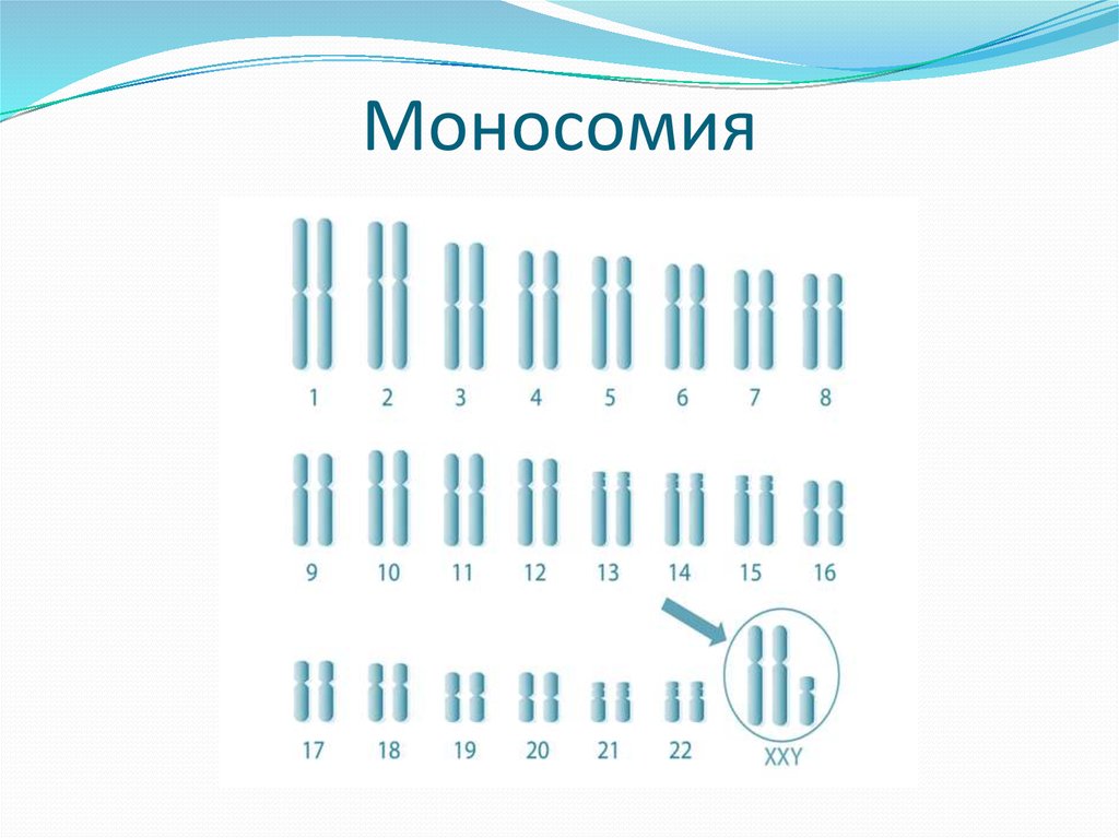 Кариотип 45. Моносомия по у хромосоме. Изменение кариотипа.