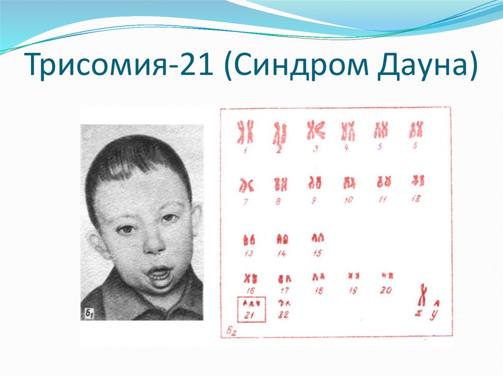 Синдром дауна механизм. Синдром Дауна трисомия по 21 хромосоме. Синдром Дауна трисомия 21 хромосомы. Трисомия 21 хромосомы (синдром Дауна кариотип. Синдром Дауна (трисомия по 21-Ой хромосоме);.