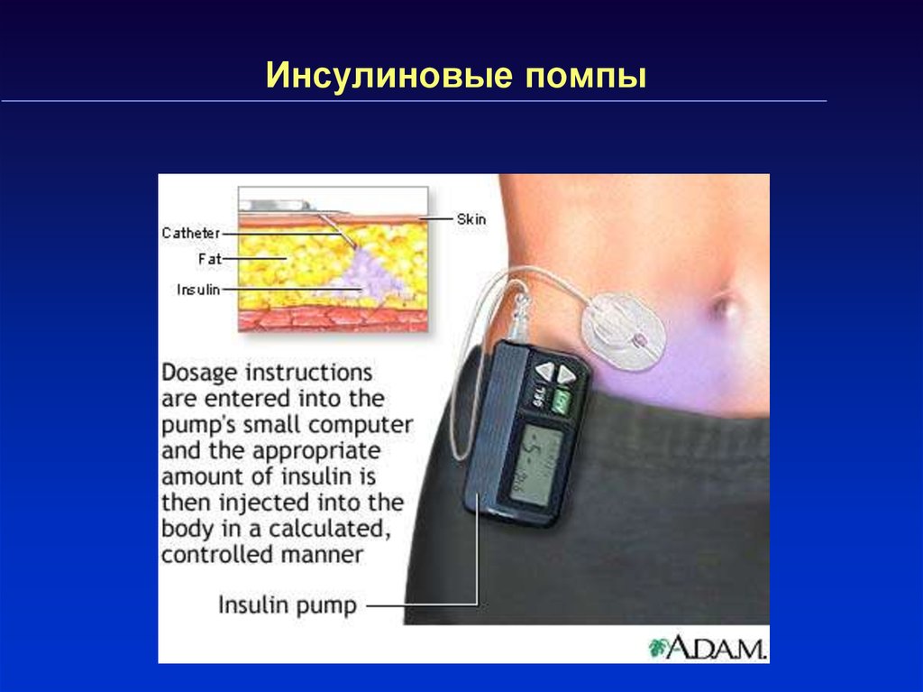 Инсулиновые помпы презентация