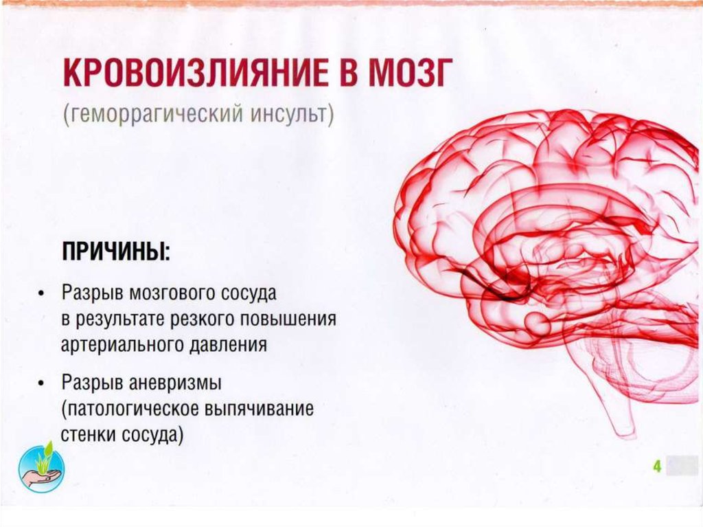 Левое полушарие мозга инсульт. Кровоизлияние в мозг симптомы. Кровоизлеяние в Можг причин. Кровоизлияние в мозг это инсульт. Кровоизлияние в мозг причины признаки.