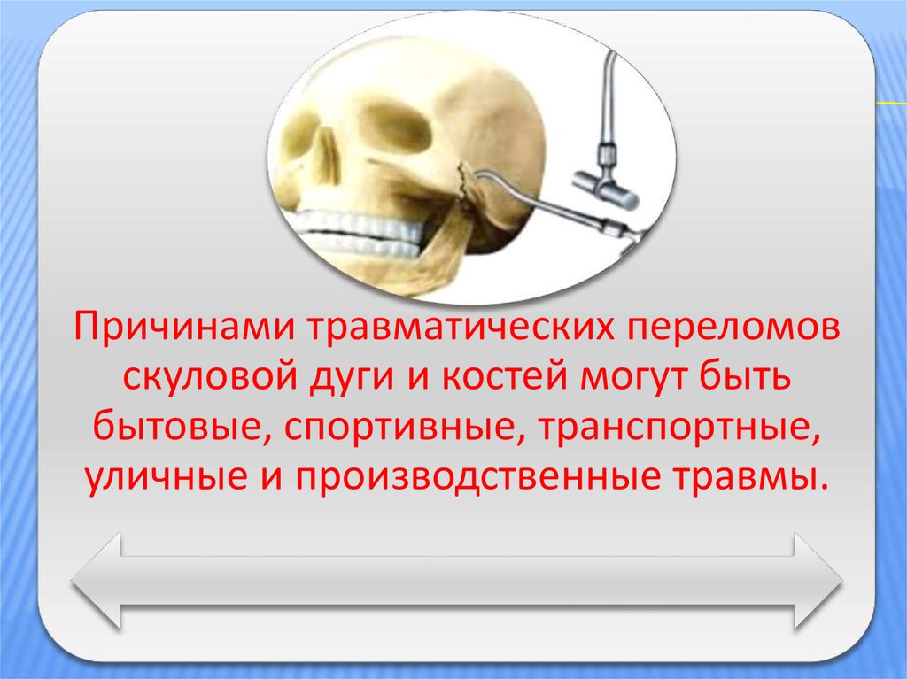 Переломы скуловой кости и дуги презентация