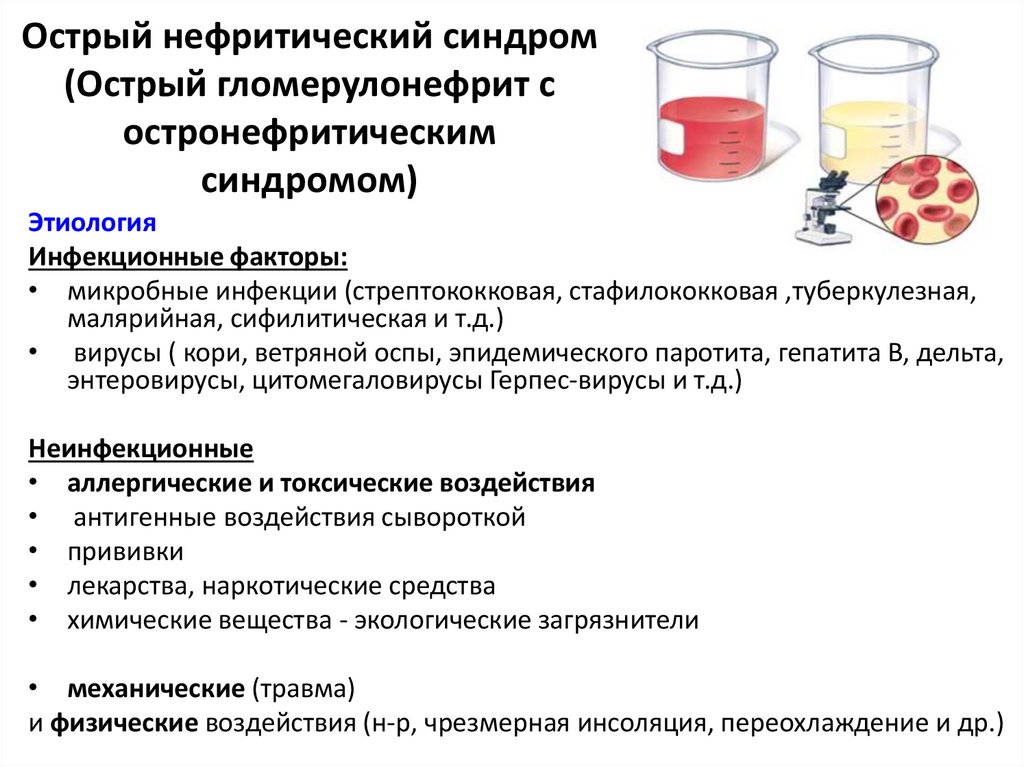 Основная причина гломерулонефрита тест. Нефритический синдром при остром гломерулонефрите. Гломерулонефрит с нефритическим синдромом. Острый нефритический синдром препараты. Нефритический синдром симптоматика.