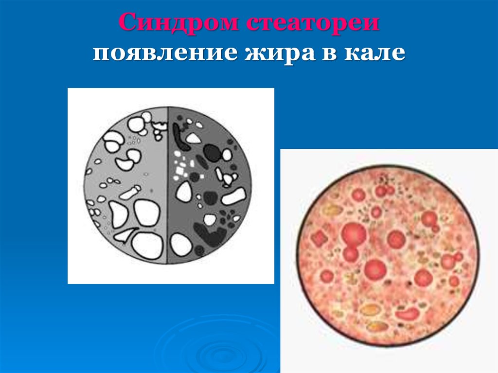 Стеаторея признаки. Стеаторея. Стеаторея синдром. Стеаторея причины биохимия.