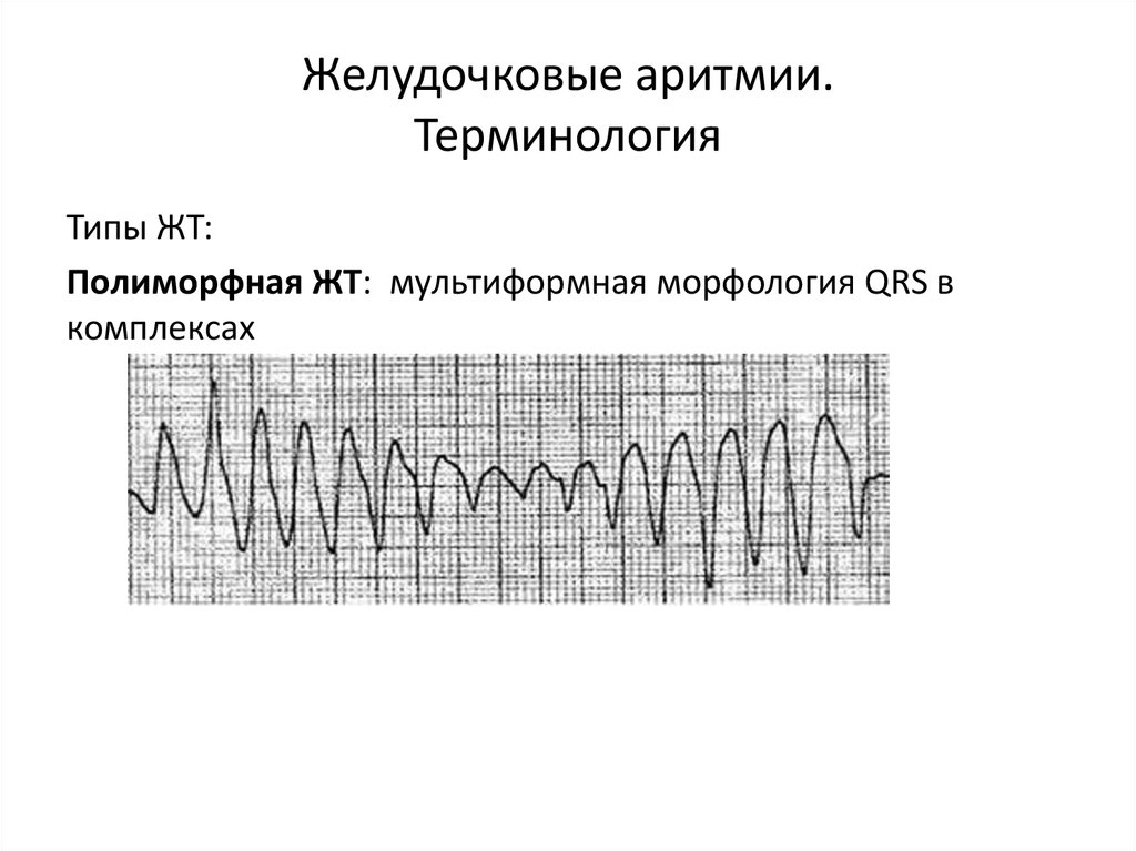 Желудочковая аритмия. Желудочковый ритм. Полиморфная желудочковая аритмия. Вентрикулярная аритмия.