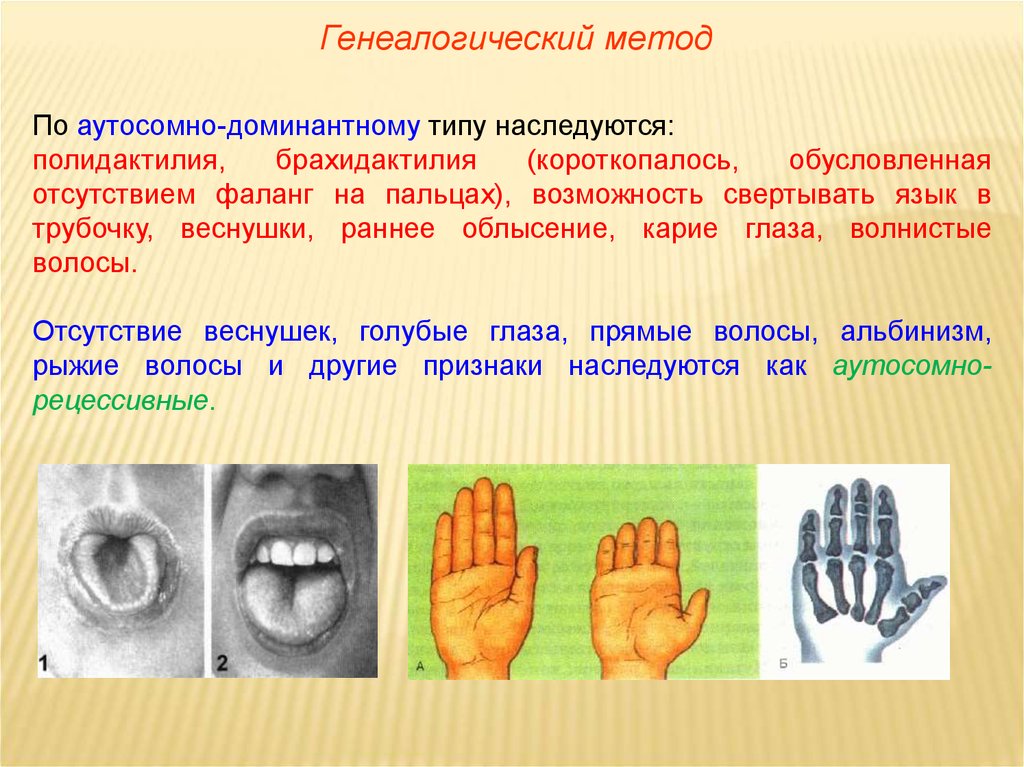 Доминантные заболевания. Полидактилия Тип наследования. Полидактилия аутосомно доминантный. По аутосомно-доминантному типу наследуется брахидактилия. Брахидактилия Тип наследования.