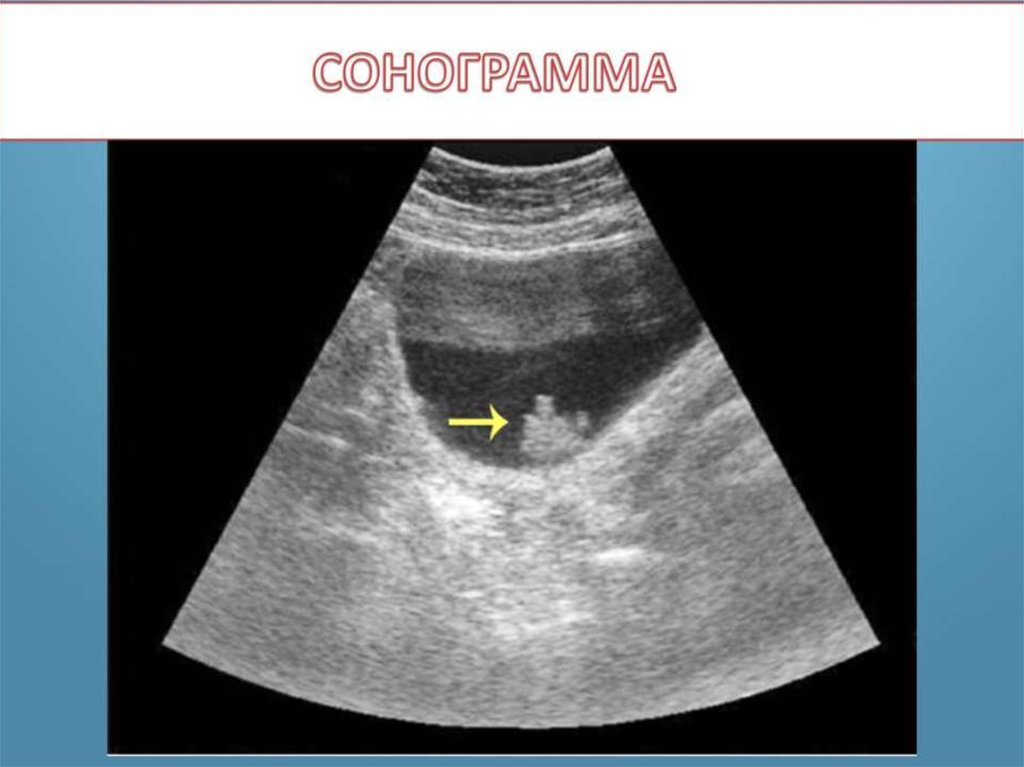 Рак мочевого 4 стадия. Полип мочевого пузыря на УЗИ. Опухоль мочевого пузыря сонограмма. Объемное образование мочевого пузыря. Опухоль мочевого пузыря УЗИ.