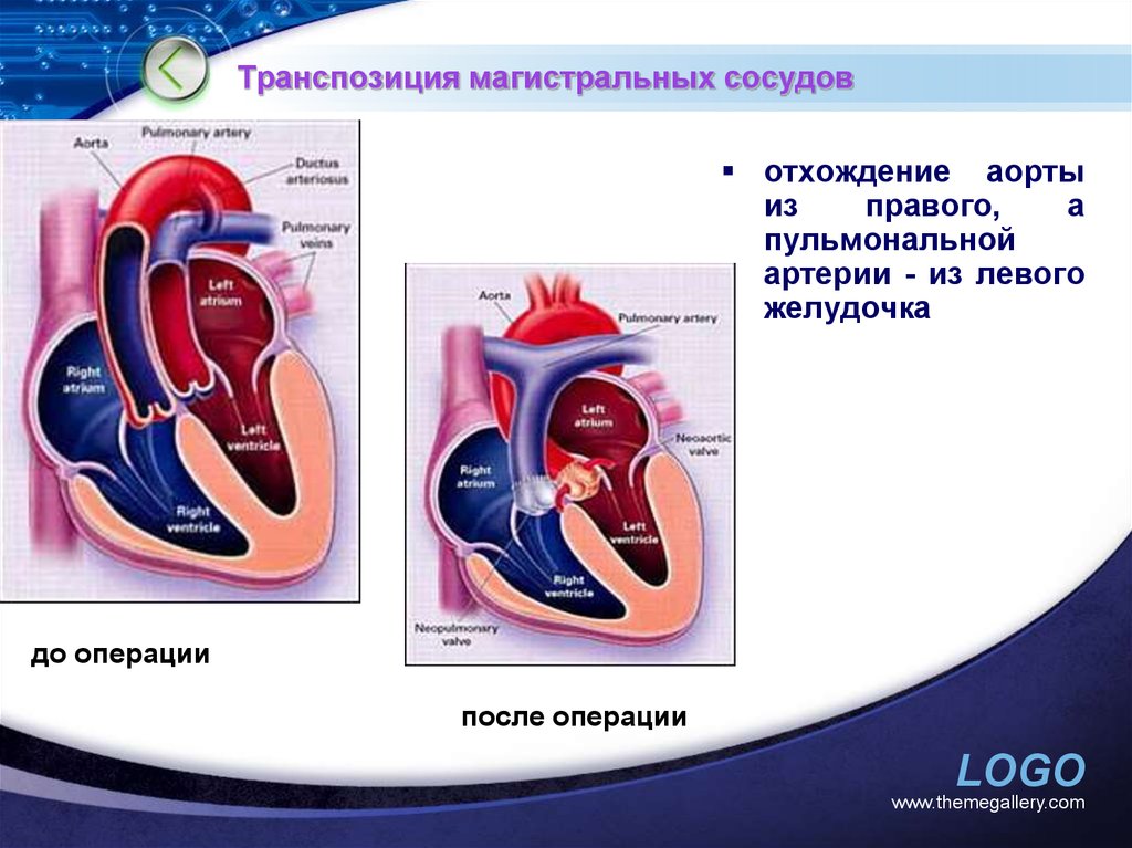 Магистральные сосуды это. Транспозиция магистральных сосудов. Транспозиция магистральных сосудов операция. Магистральные сосуды. ВПС транспозиция магистральных сосудов.
