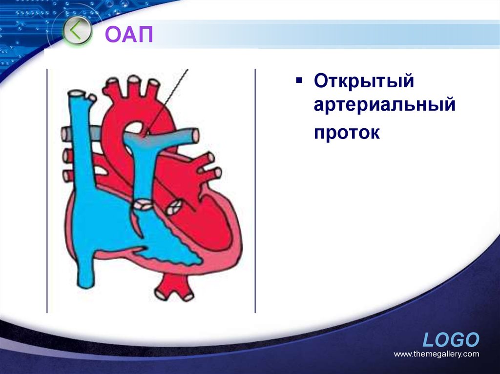Оап у новорожденных. Открытый артериальный (боталлов) проток. Открытый артериальный проток (ОАП). Открытый Баталов проток. Открытый артериальный проток боталлов проток.