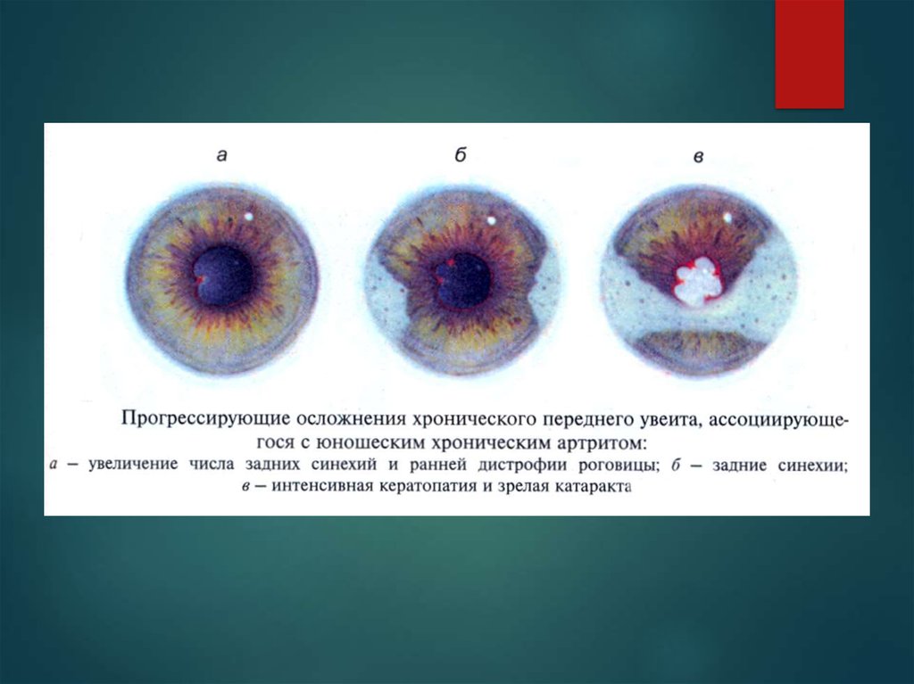 Патология сосудистой оболочки глаза презентация