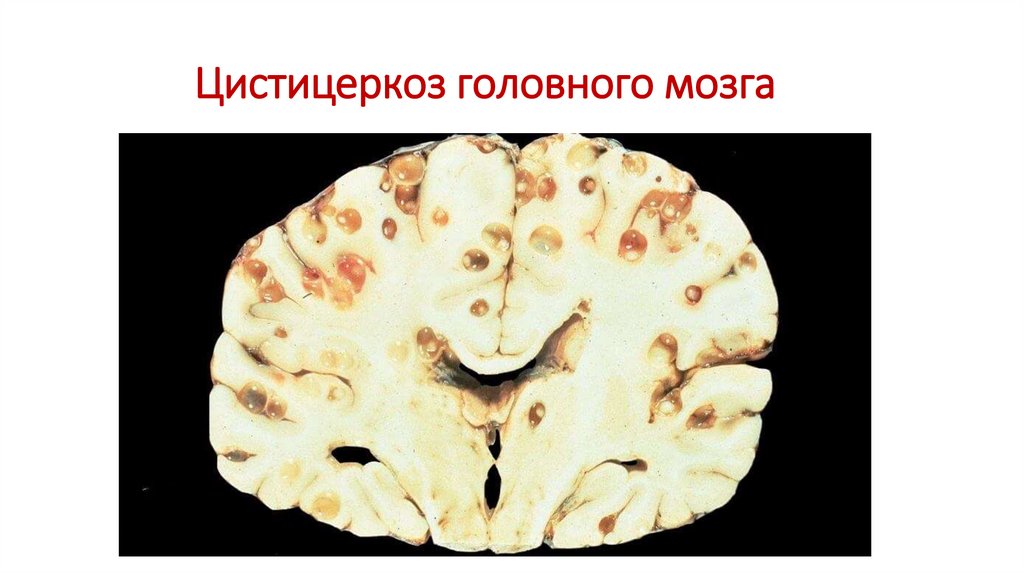 Цистицеркоз головного мозга