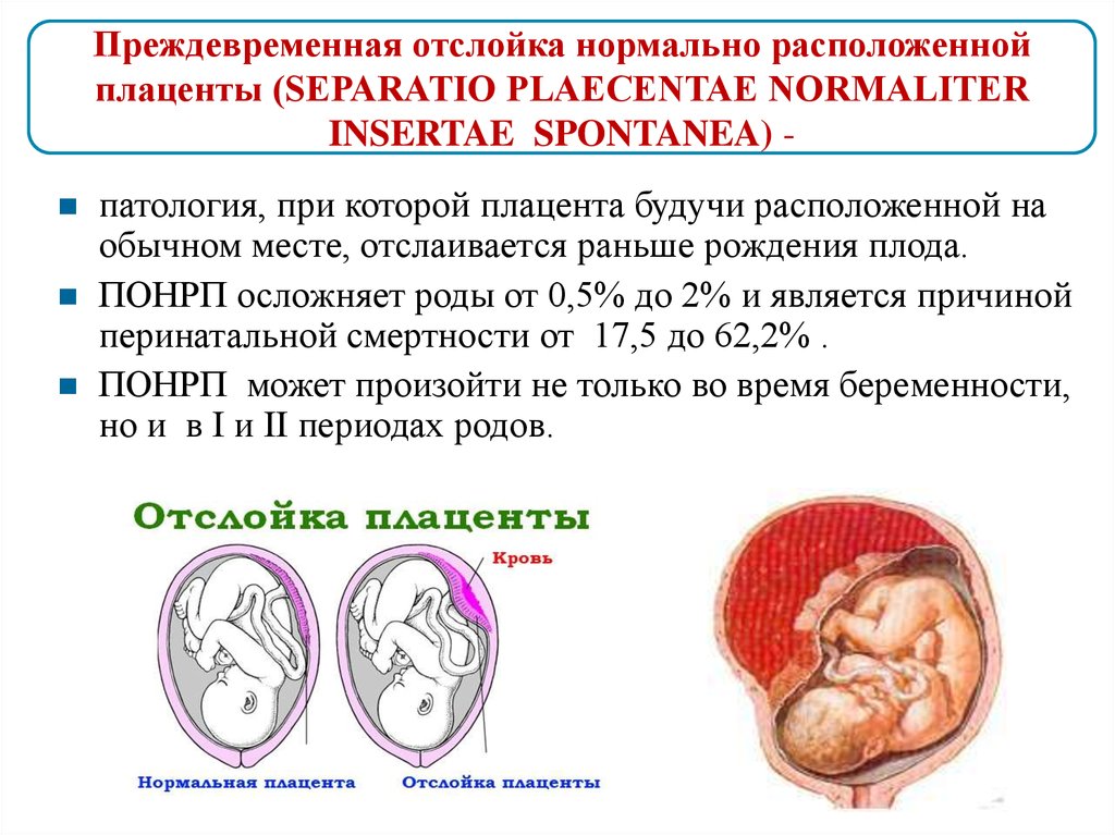 Кровотечение на поздних сроках беременности. Преждевременное отслоение нормально расположенной плаценты. Преждевременная отслойка низко расположенной плаценты. Предлежание плаценты при беременности 12 недель. Осложнения преждевременной отслойки плаценты.