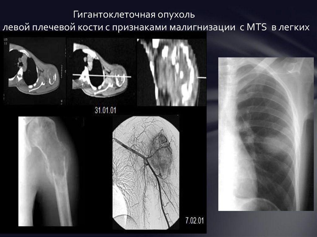 Первичные злокачественные опухоли костей