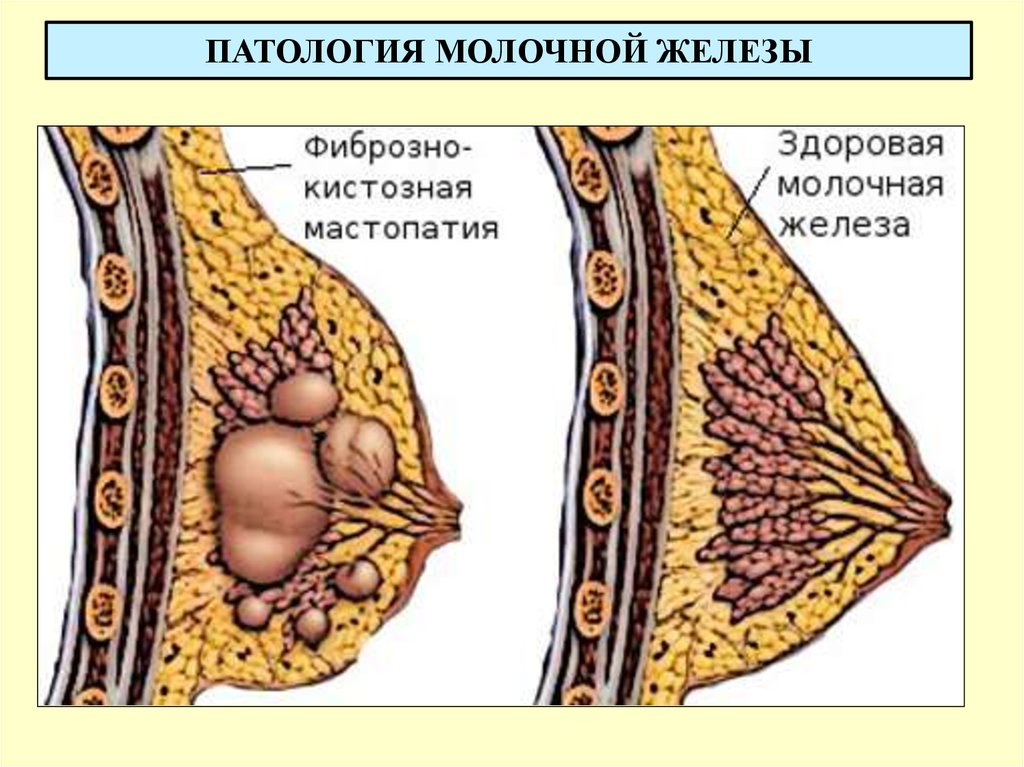 ПАТОЛОГИЯ МОЛОЧНОЙ ЖЕЛЕЗЫ