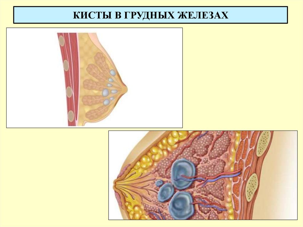 Киста в груди. Субареолярная киста молочной железы. Солитарная киста молочной железы что это такое. Жировая киста молочной железы.