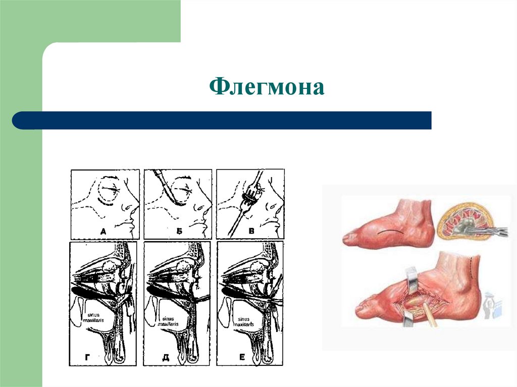 Флегмона лица карта вызова смп