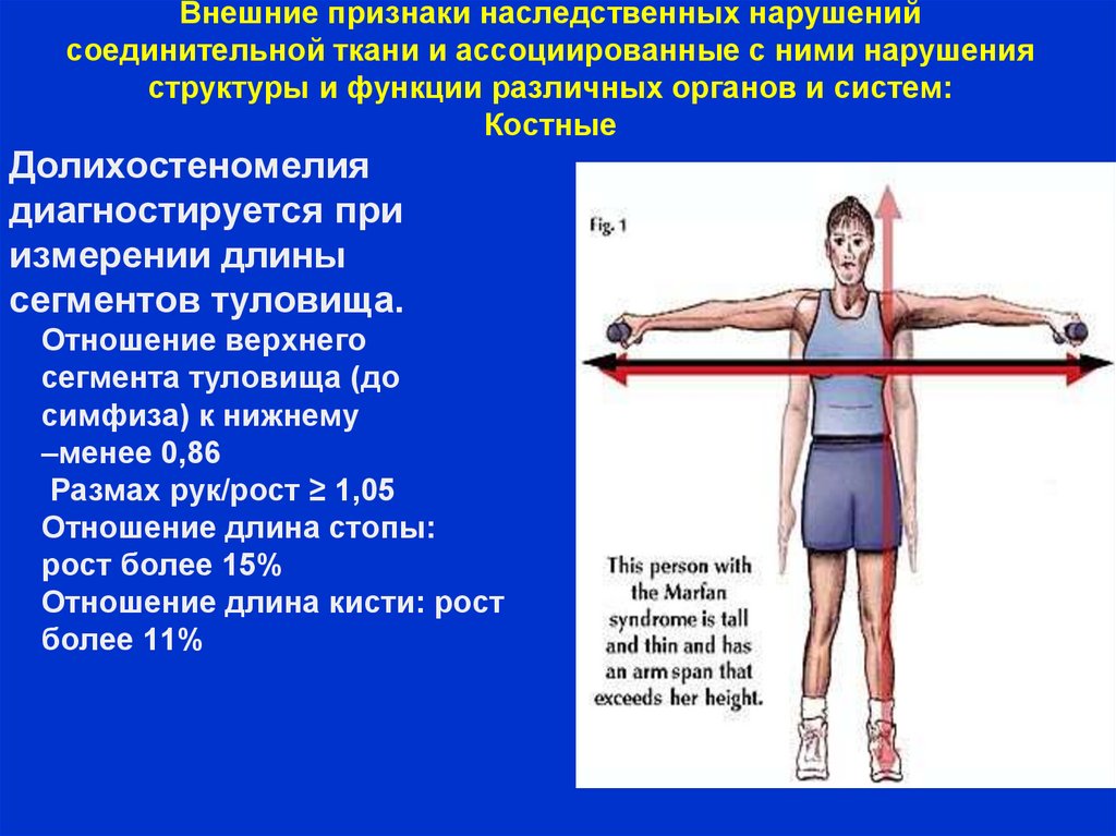 Дисплазия соединительной ткани картинки