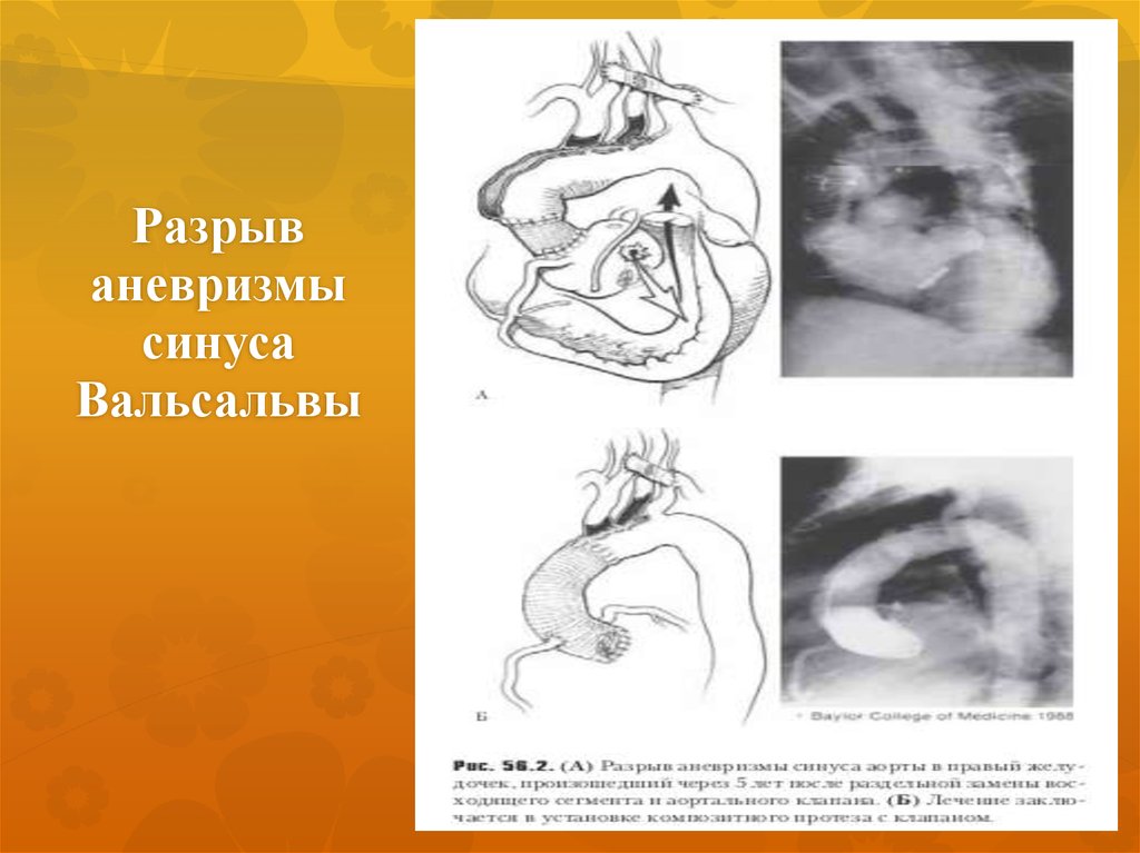 Аневризма синуса. Аневризма коронарного синуса ЭХОКГ. Аневризма синуса Вальсальвы. Аневризма синуса Вальсальвы ЭХОКГ.