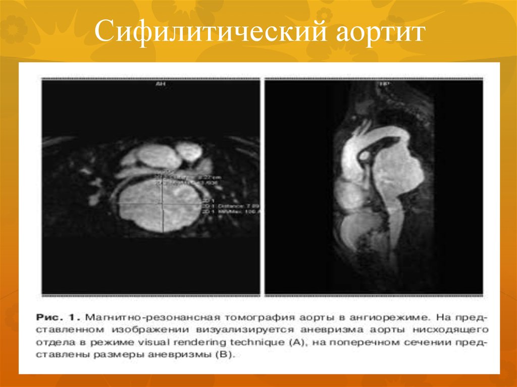 Аортит. Сифилитический аортит. Сифилитическая аневризма. Аневризма презентации. Сифилитический мезаортит.