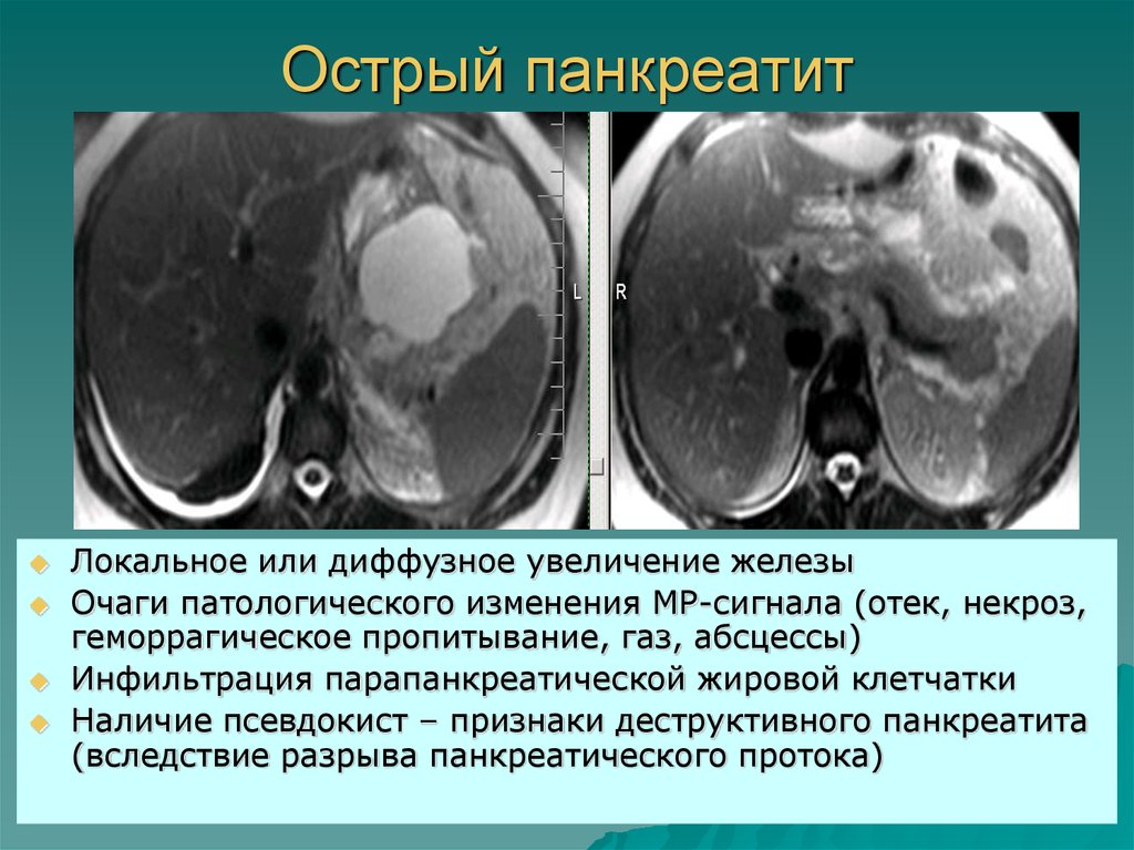 Диффузная железа. Острый некротический панкреатит кт. Геморрагический панкреатит кт. Кт признаки острого панкреатита. Мрт при остром панкреатите.