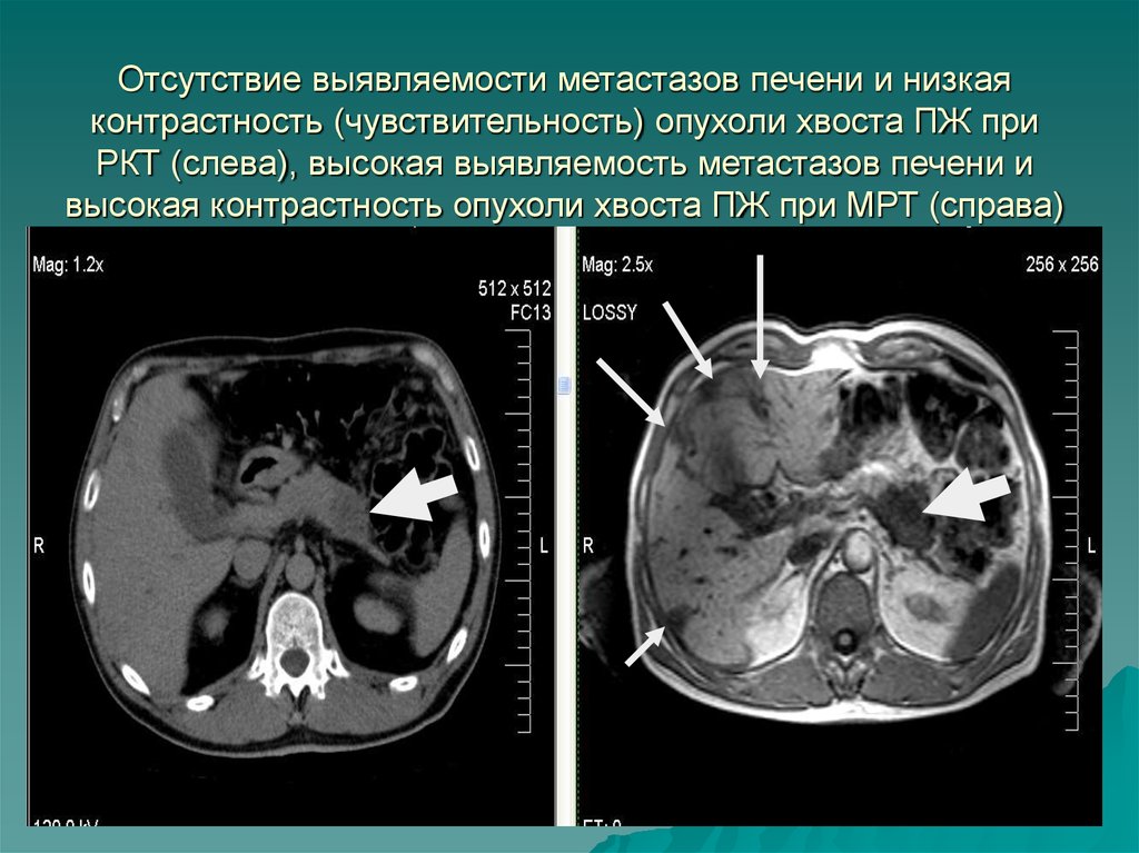 Мрт печени