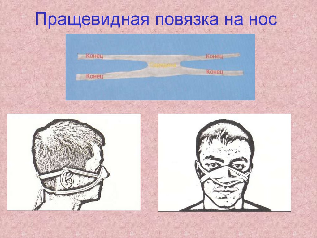 Пращевидная повязка. Наложение повязки на нос пращевидная повязка алгоритм. Пращевидная повязка на нос техника. Пращенвидная повязка н Анос. Повязка на нос при переломе.