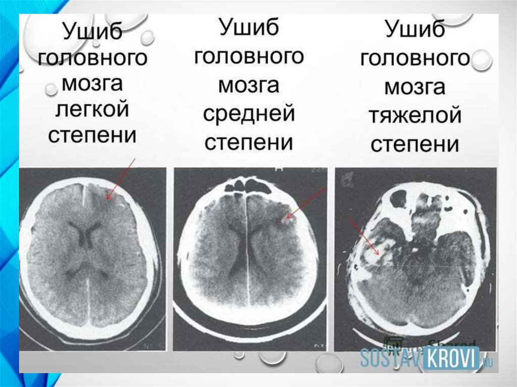 Сотрясение средней тяжести