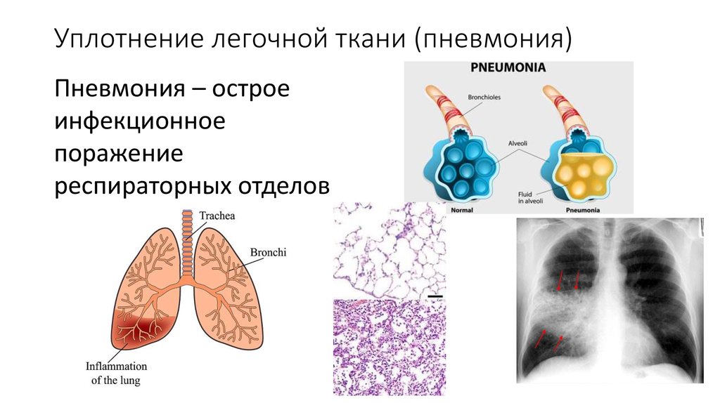 Поражение легочных тканей