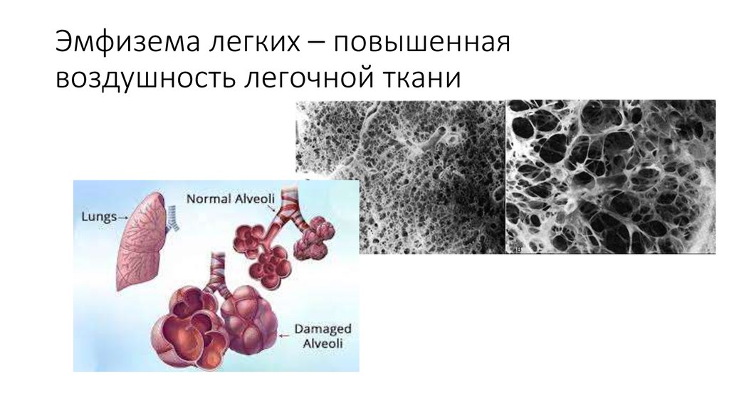 1 эмфизема легких