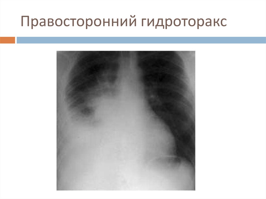 Гидроторакс это. Тотальный правосторонний гидроторакс. Правосторонний малый гидроторакс. Правосторонний плеврит это гидроторакс. Реактивный гидроторакс.