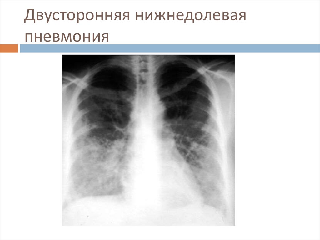 Пневмония в правом легком в нижней доле. Внебольничная двухсторонняя нижнедолевая пневмония. Двухсторонняя нижнедолевая пневмония рентген. Внебольничная нижнедолевая пневмония рентген. Рентгенологическая картина двусторонней пневмонии.
