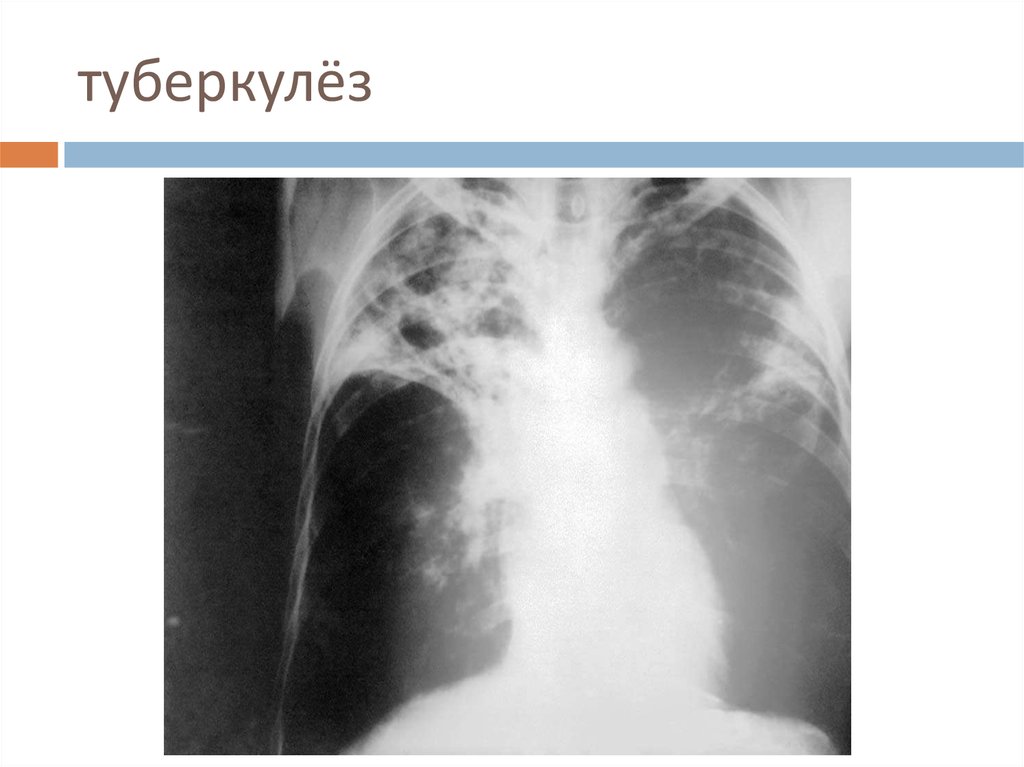 Новый штамм туберкулеза в британии