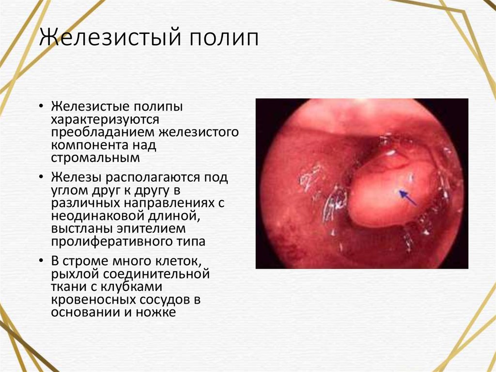 Полипы эндометрия: как и где лечиться?