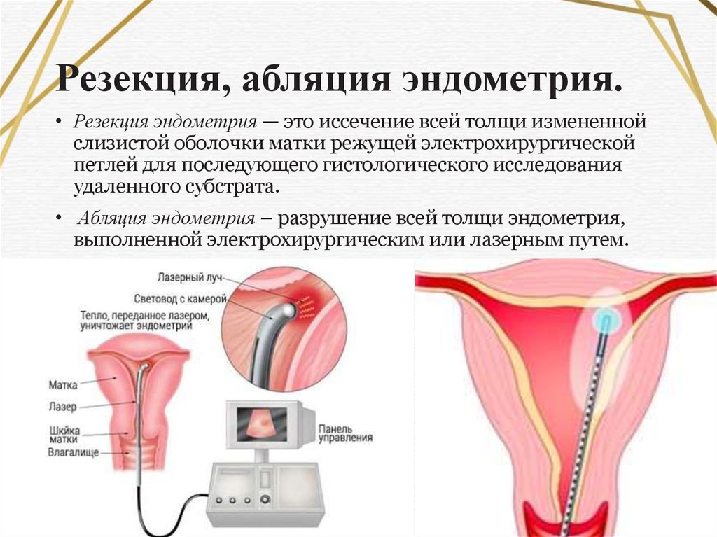Операция по удалению эндометрия матки. Абляция эндометрия гистероскопическая. Гиперплазия эндометрия выскабливание. Резекцию или абляцию эндометрия.