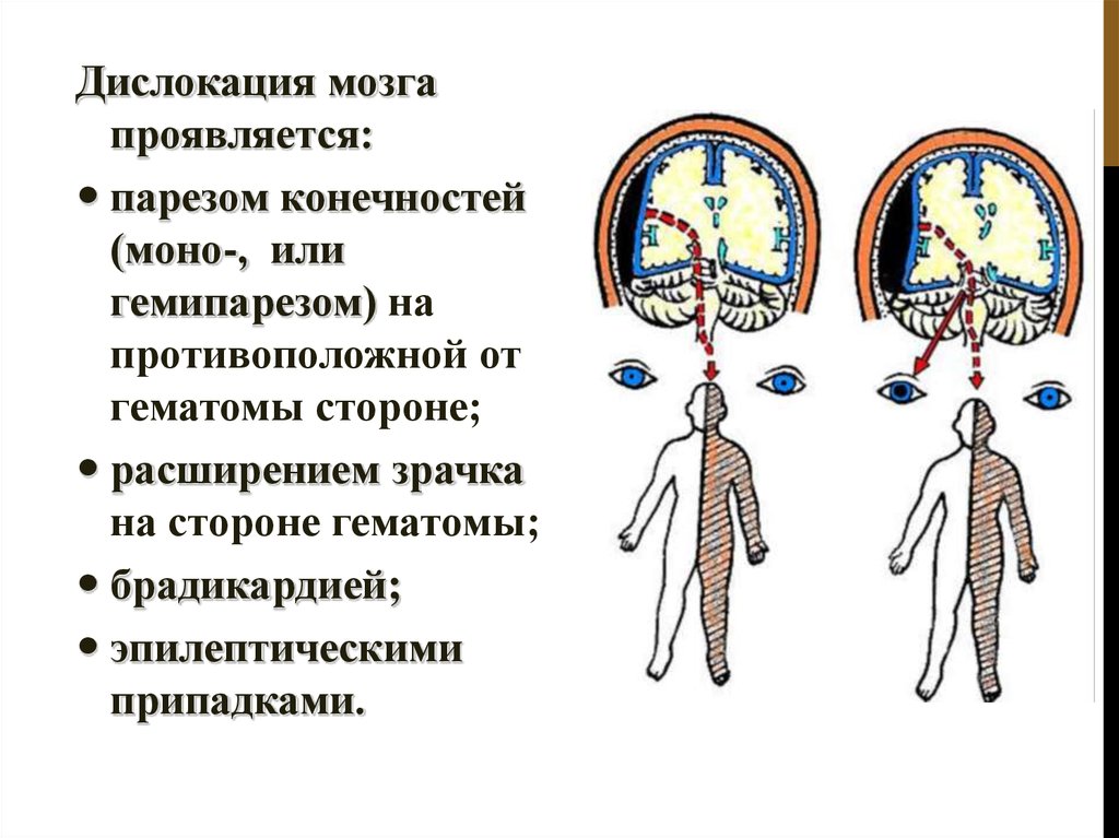 Признаки дислокации