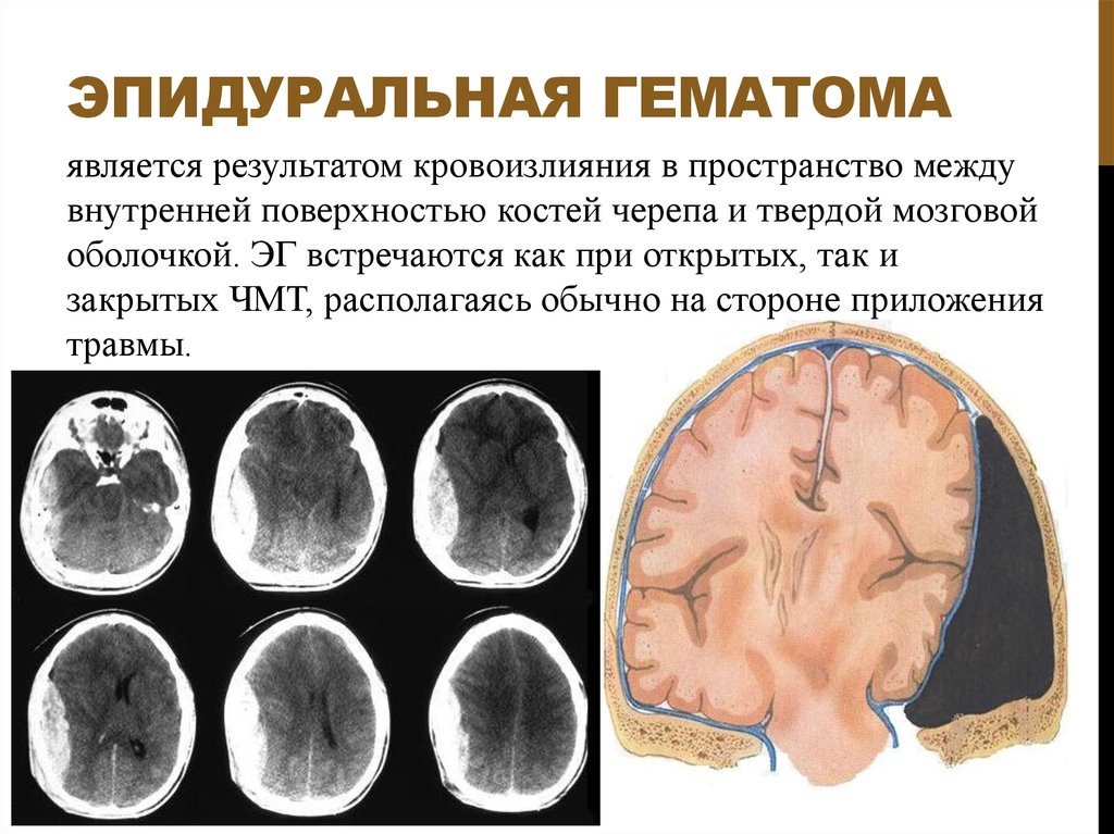 Гематома черепно мозговой травме. Субдуральная гематома и эпидуральная головного. Эпидуральная гематома головного мозга на кт. Эпидуральная гематома топографическая анатомия.