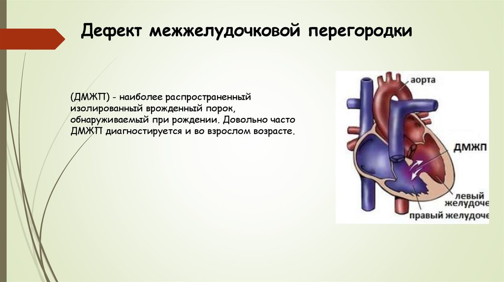 Межжелудочковая перегородка. Отточный дефект межжелудочковой перегородки. Врожденный порок сердца дефект межжелудочной перегородки. Рестриктивный дефект межжелудочковой перегородки.