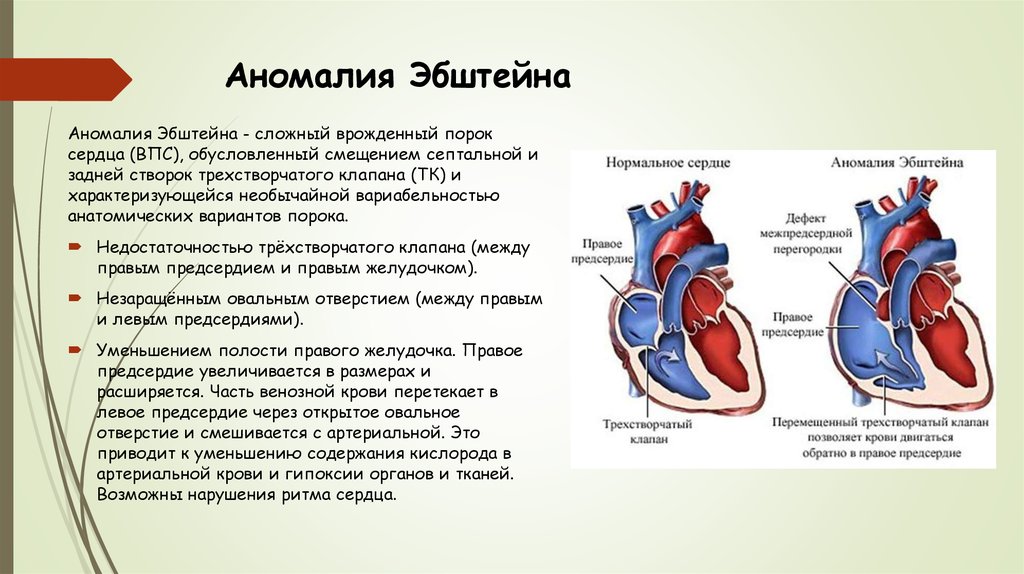 Порог сердца что это. Аномалия Эбштейна сердца врожденный порок сердца. Врожденный порок сердца Эпштейна. Аномалия Эбштейна сердца клинические рекомендации. Порок сердца синдром Эпштейна.